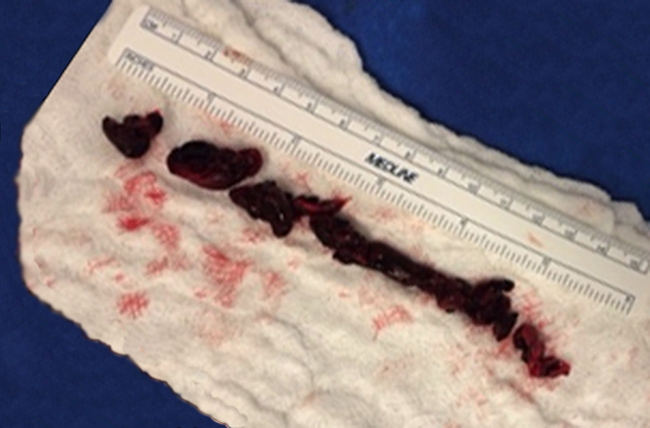 Clot removed from the pulmonary artery through embolectomy